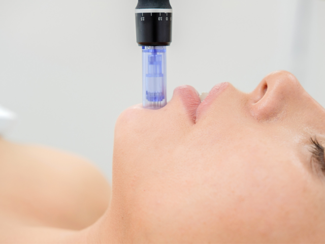 Microneedling, l&#39;arme secrète anti-âge